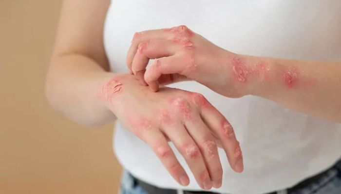 Kenapa Badan Sering Gatal dan Bentol? Ini 2 Penyebab Utamanya